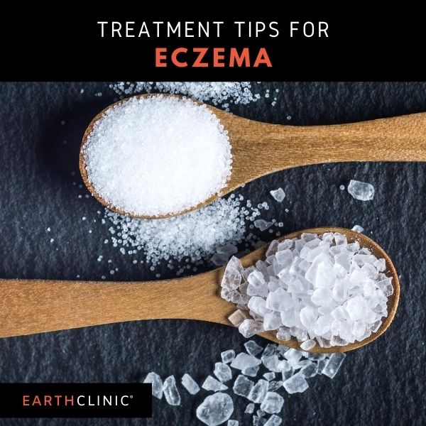 Natural Remedies for Eczema